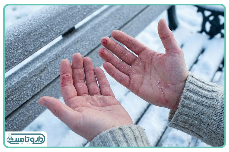 خشکی پوست و مفاصل؛ نقش اسیدهای چرب