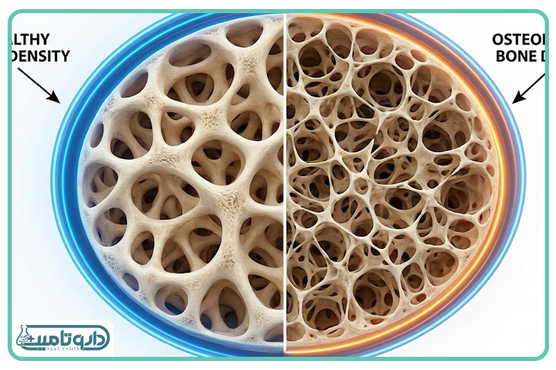 پوکی استخوان