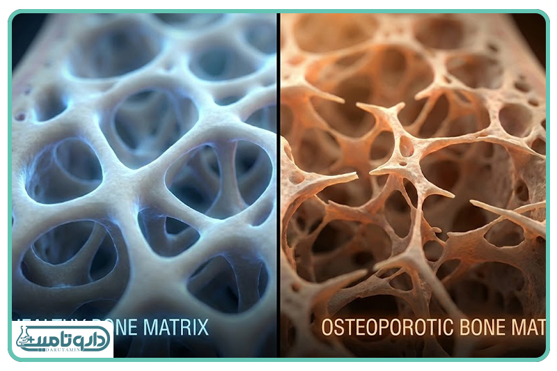 پوکی استخوان