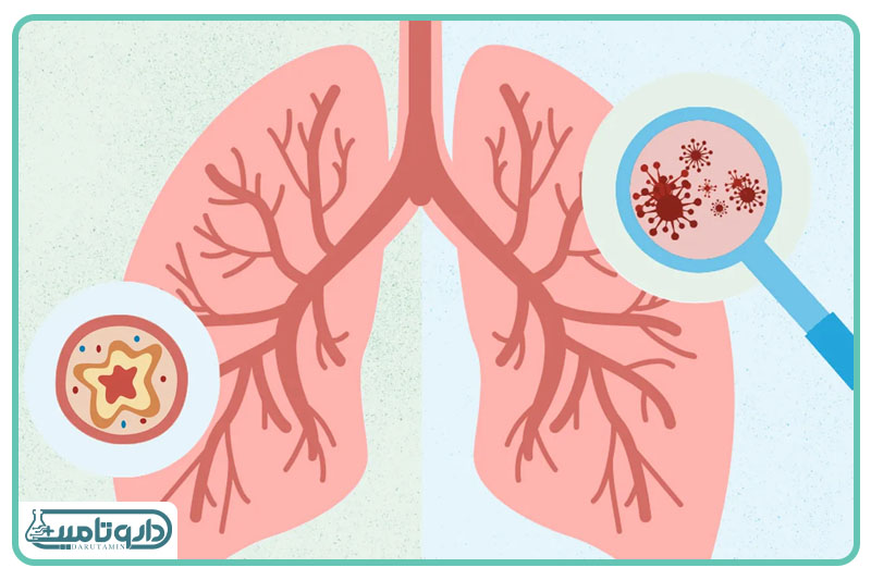 برونشیت گلو