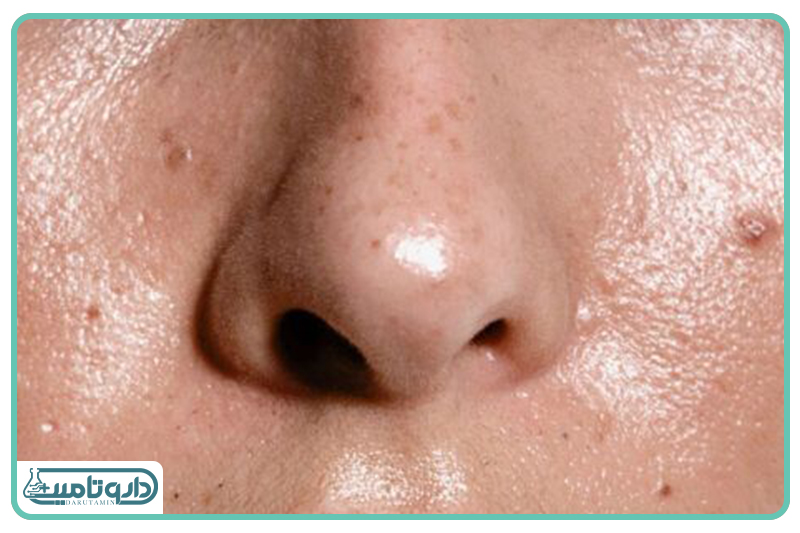 پوست مختلط تا چرب