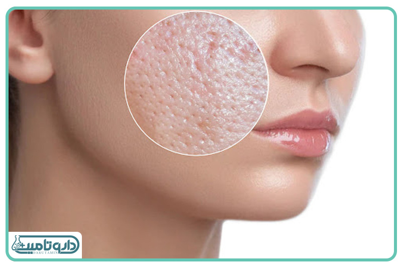 پاکسازی منافذ پوست