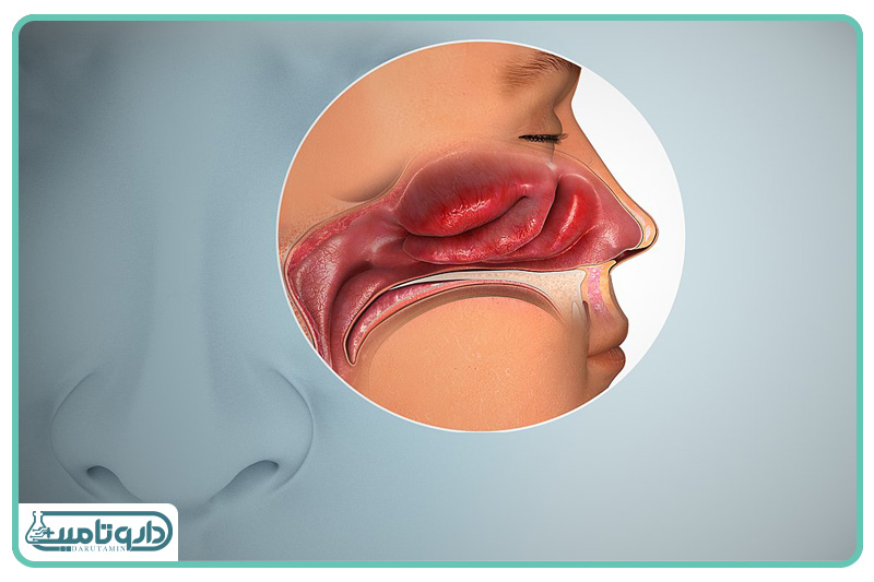 التهاب مخاط بینی