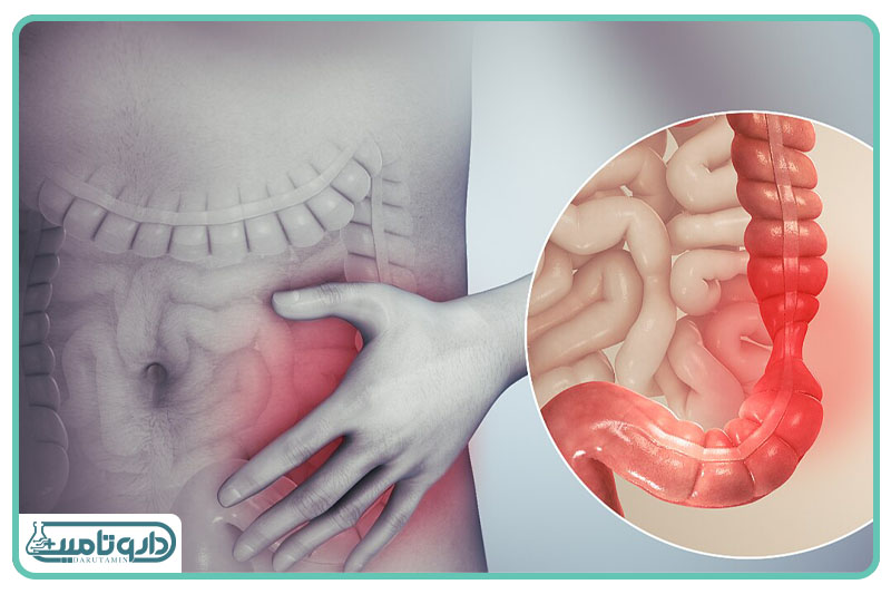 اسپاسم گوارشی