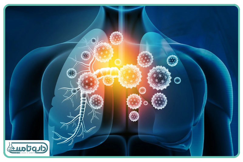 عفونت تنفسی