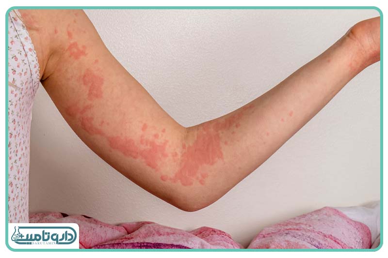 واکنش آلرژیک