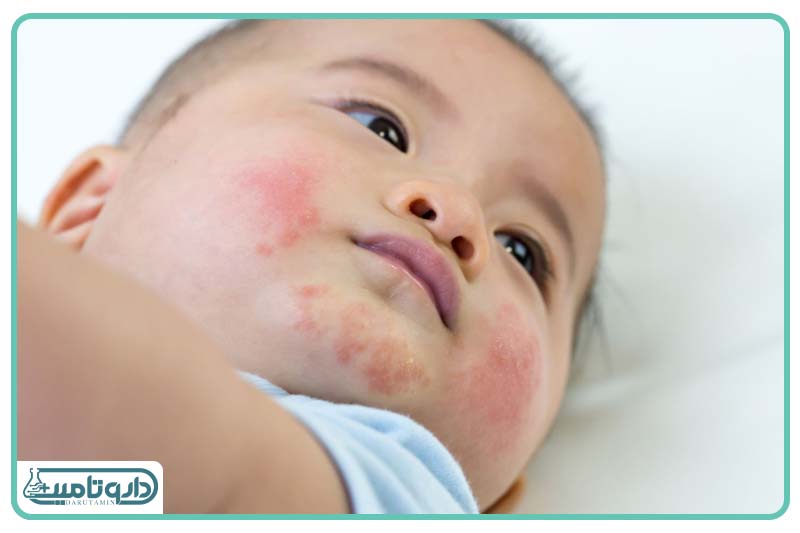 واکنش آلرژیک