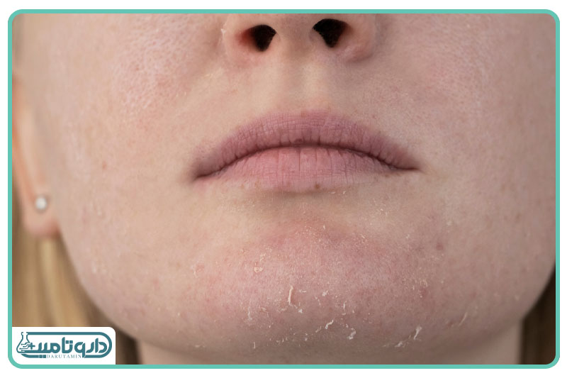 پوست خشک و دهیدراته